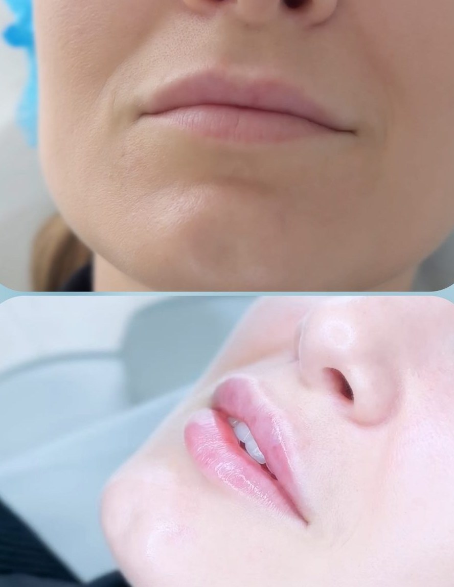 Rezultat conturare buze cu acid hialuronic, înainte și după